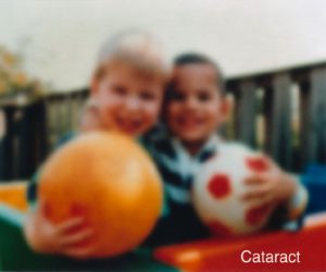 Impaired vision with cataract