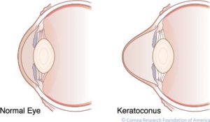 Normal eye shape versus keratoconus