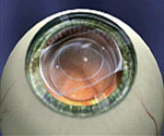 Phakic intraocular lens implant
